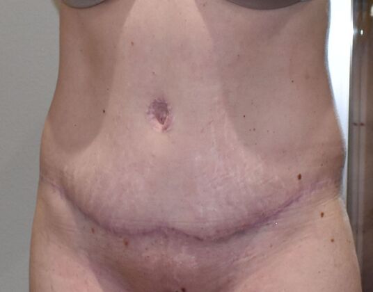 Tummy Tuck (Abdominoplasty): Case 589 - After