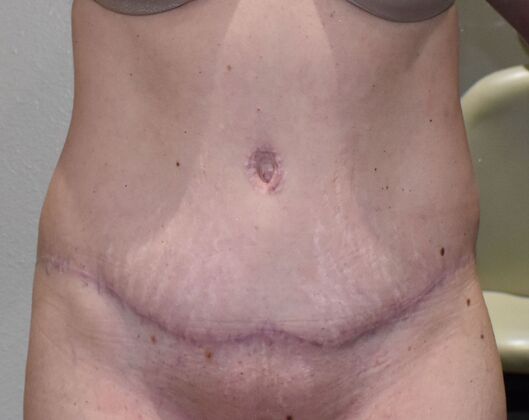 Tummy Tuck (Abdominoplasty): Case 589 - After