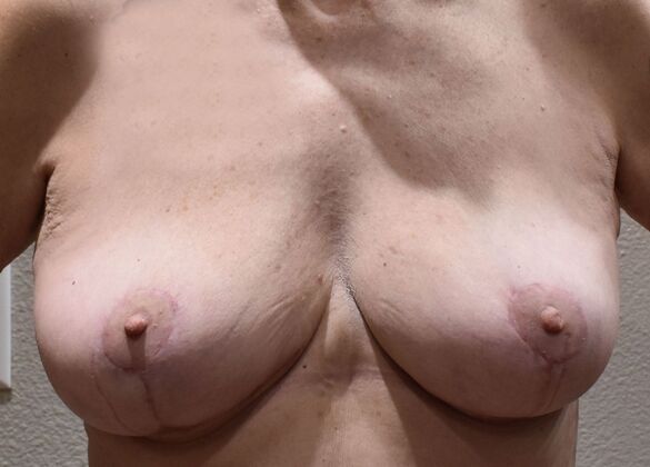 Breast Reduction: Case 218 - After