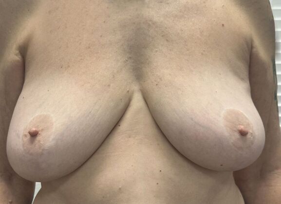Breast Reduction: Case 218 - Before