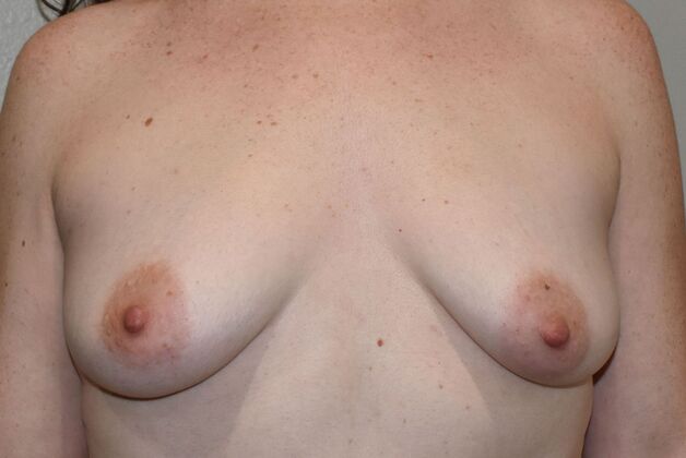 Breast Augmentation Case 505 - Before