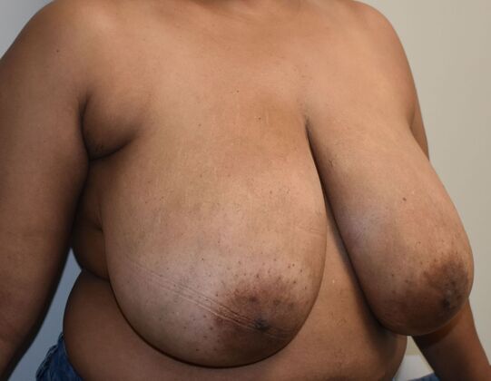 Breast Reduction: Case 219 - Before