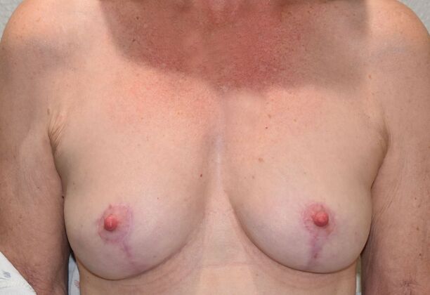 Breast Lift (Mastopexy): Case 271 - After