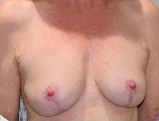 Breast Lift (Mastopexy): Case 271 - After