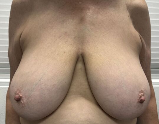 Breast Reduction: Case 220 - Before