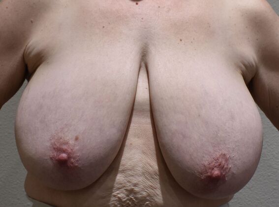 Breast Reduction: Case 221 - Before