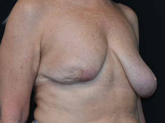Mastopexy: Case 13 - Before