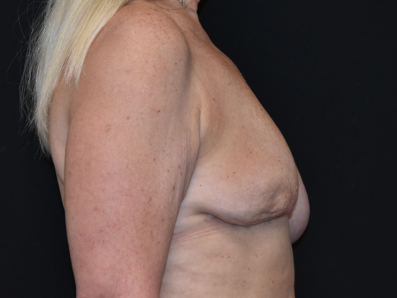 Mastopexy: Case 13 - Before