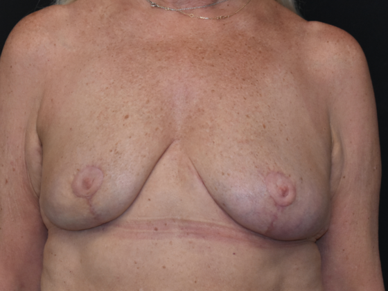 Mastopexy Case 13 - After