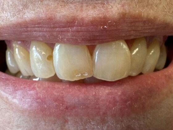 Fillings Case 2 - Before