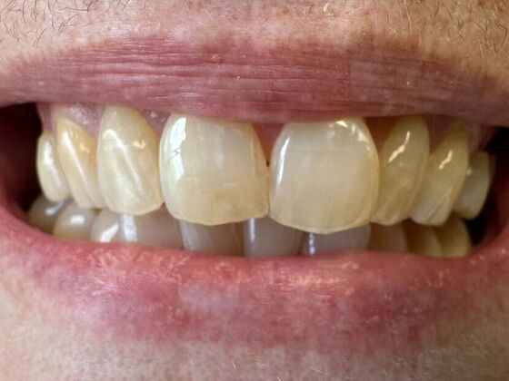 Fillings Case 2 - After