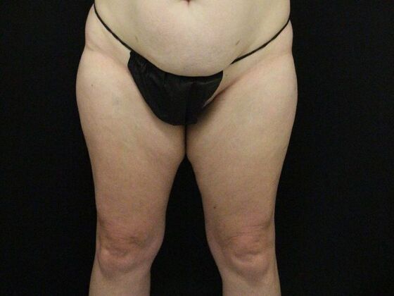 Thigh Lift Case 11 - Before