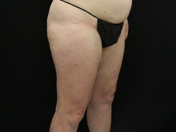 Thigh Lift: Case 11 - Before