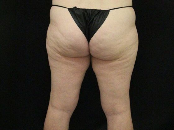 Thigh Lift: Case 11 - Before