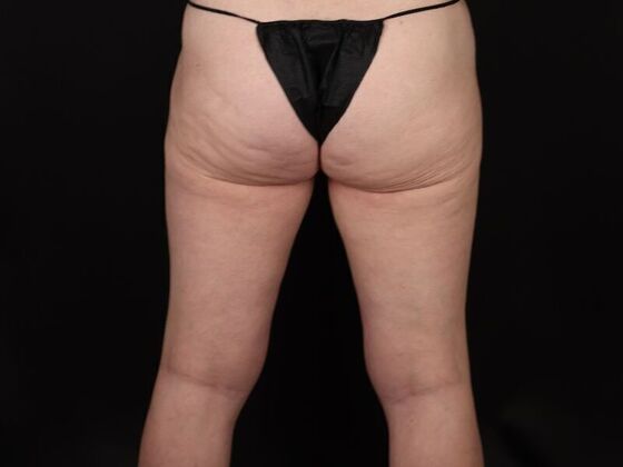 Thigh Lift: Case 11 - After