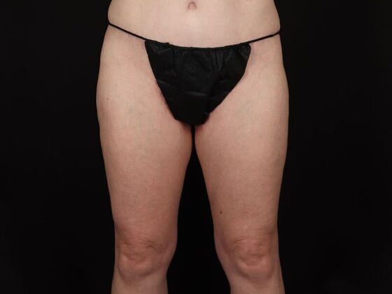 Thigh Lift Case 11 - After