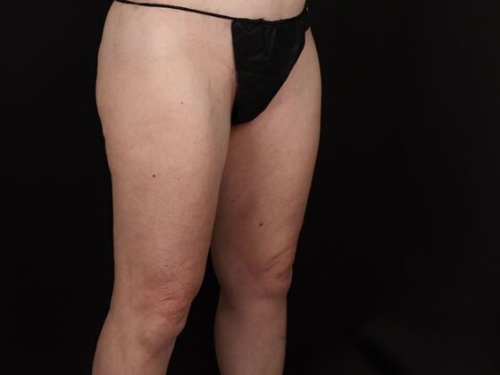 Thigh Lift: Case 11 - After