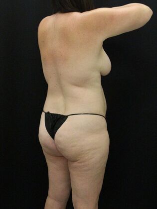 Liposuction: Case 46 - Before