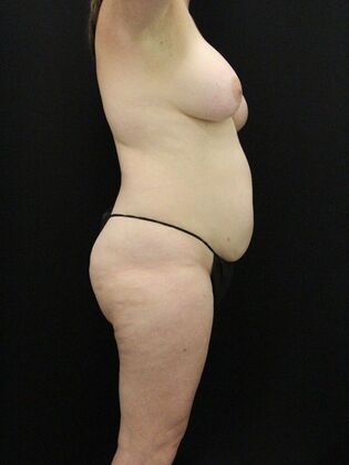 Liposuction: Case 46 - Before