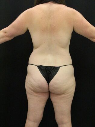 Liposuction: Case 46 - Before