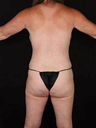 Liposuction: Case 46 - After