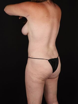 Liposuction: Case 46 - After