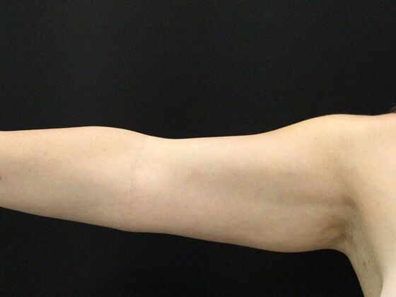 Arm Lift: Case 28 - Before