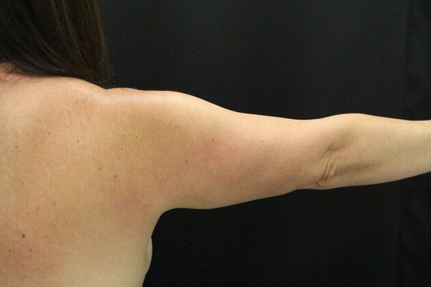 Arm Lift Case 28 - Before