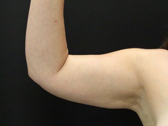 Arm Lift: Case 28 - Before