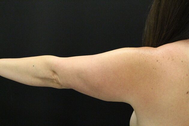 Arm Lift: Case 28 - Before