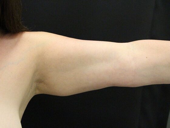 Arm Lift: Case 28 - Before