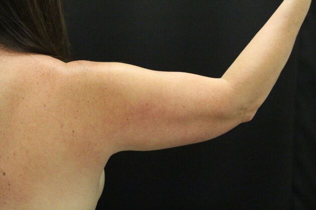 Arm Lift: Case 28 - Before