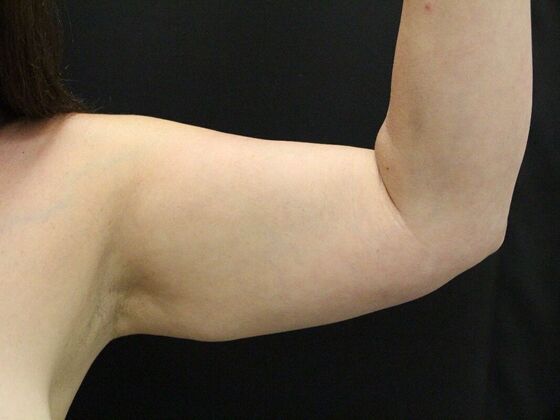 Arm Lift: Case 28 - Before
