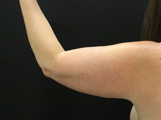 Arm Lift: Case 28 - Before