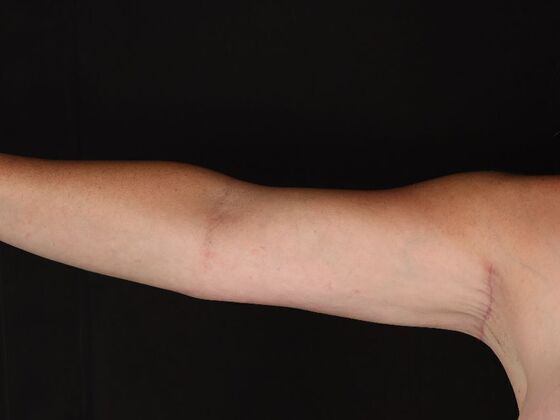 Arm Lift: Case 28 - After