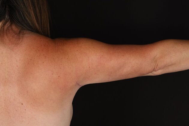 Arm Lift Case 28 - After