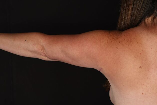 Arm Lift: Case 28 - After