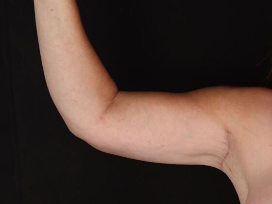 Arm Lift: Case 28 - After