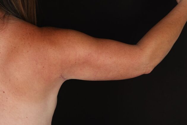 Arm Lift: Case 28 - After