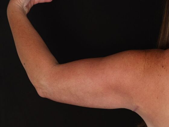 Arm Lift: Case 28 - After