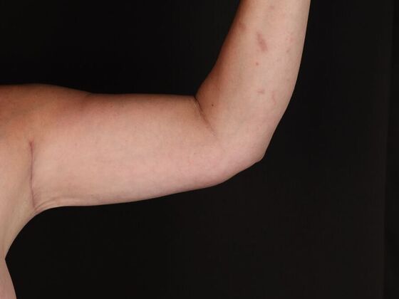 Arm Lift: Case 28 - After