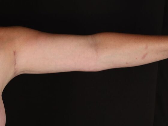 Arm Lift: Case 28 - After