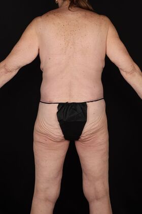 Tummy Tuck: Case 87 - After