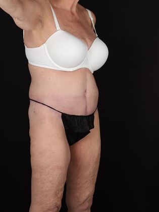 Tummy Tuck: Case 87 - After