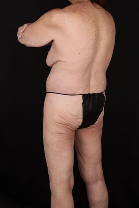 Tummy Tuck: Case 87 - After