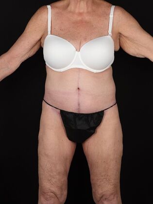 Tummy Tuck: Case 87 - After