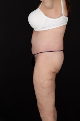 Tummy Tuck: Case 87 - After