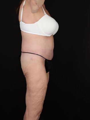 Tummy Tuck: Case 87 - After