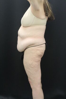 Tummy Tuck: Case 87 - Before