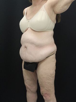 Tummy Tuck: Case 87 - Before